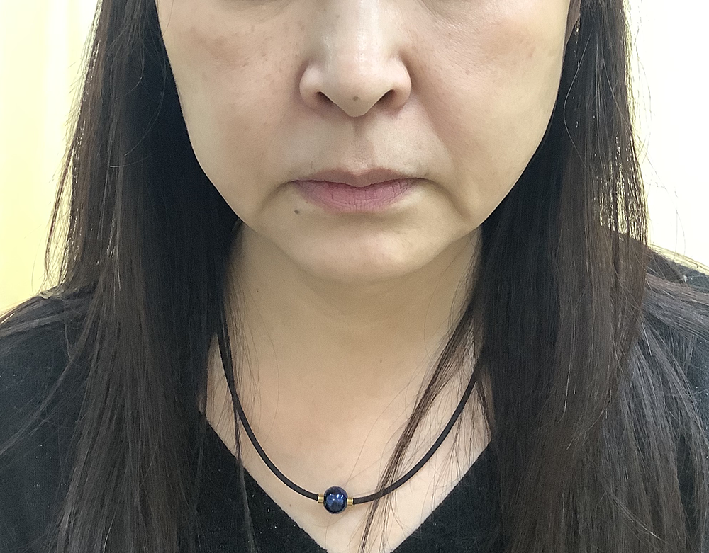 症例写真